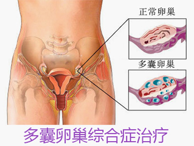 多囊卵巢是怎么得的？可以自愈吗？