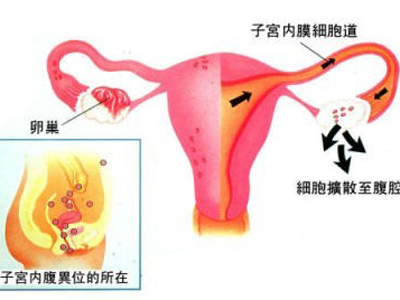 子宫内膜异位症怎么办？如何治疗怀孕快？