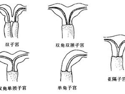 子宫发育不良怎么办