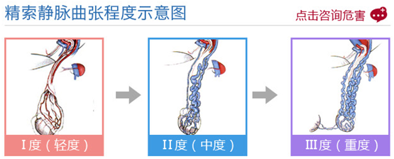 精索静脉曲张